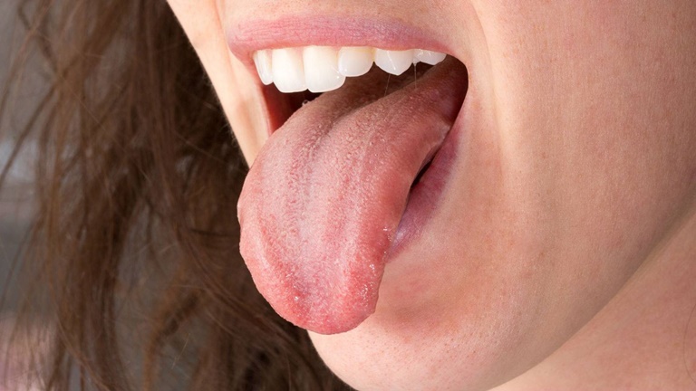 лечение сосочков языка
