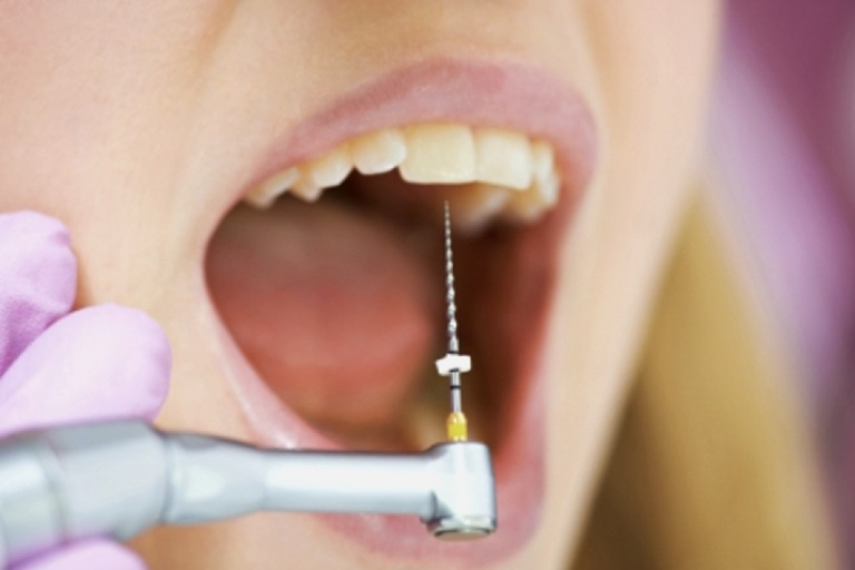 противопоказания к удалению зубного нерва