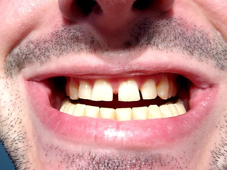 причины гниения зубов