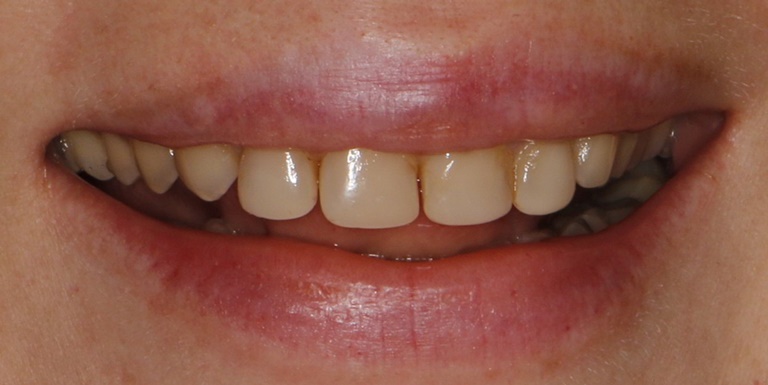 особенности кариеса между зубами