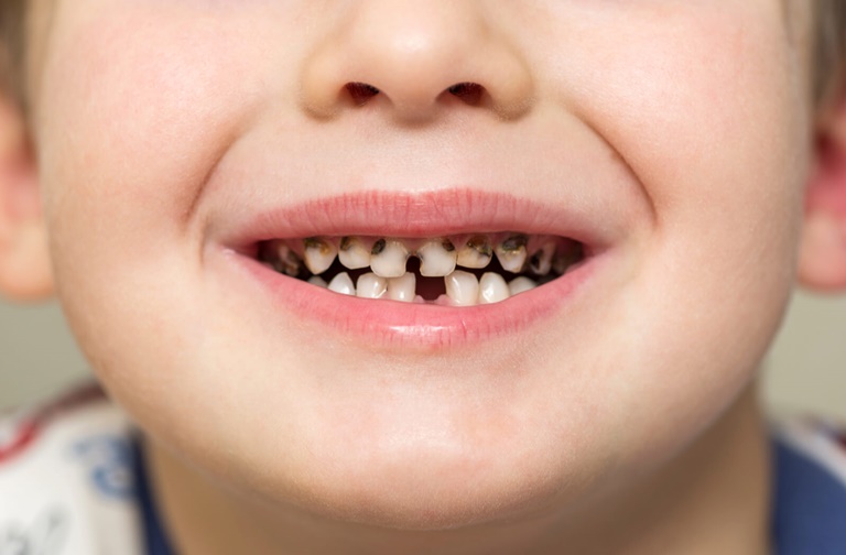 причины и симптомы гниения зубов у детей