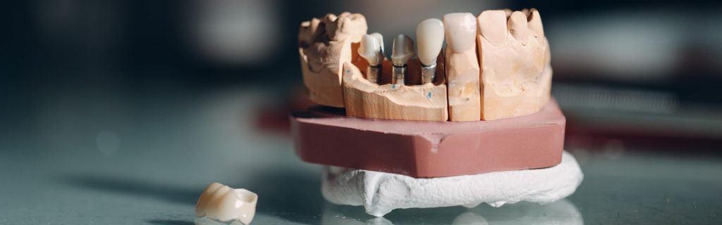 Что такое имплант зуба: плюсы и минусы, методы и этапы имплантации