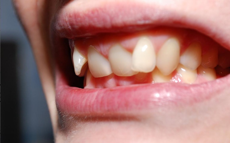 что такое дефекты зубных рядов