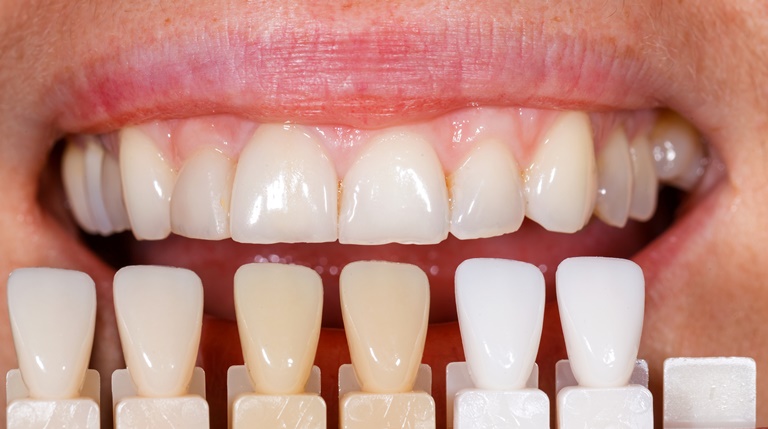 как сохранить естественную белизну зубов