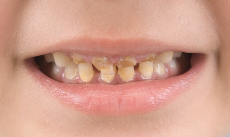 виды некариозных поражений зубов