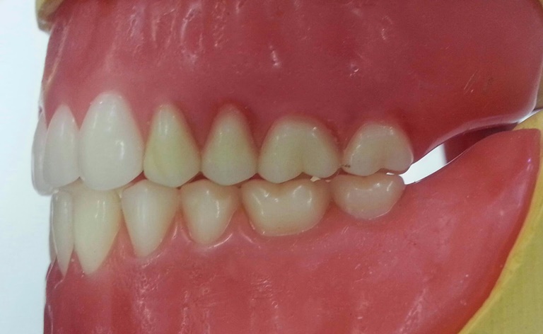 типы дефектов зубных рядов