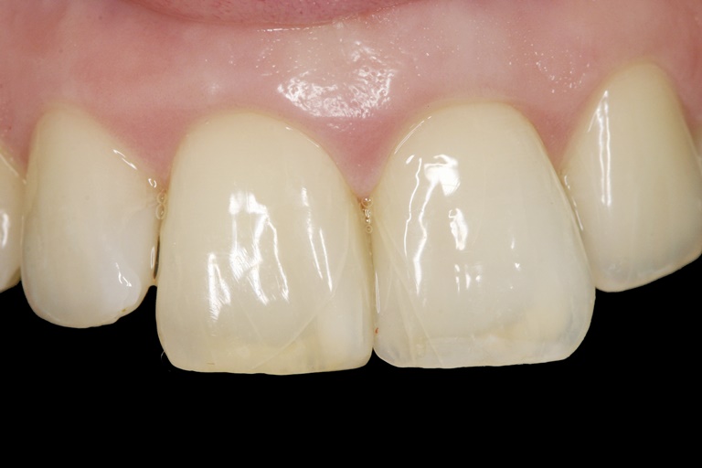 лечение некариозных поражений зубов