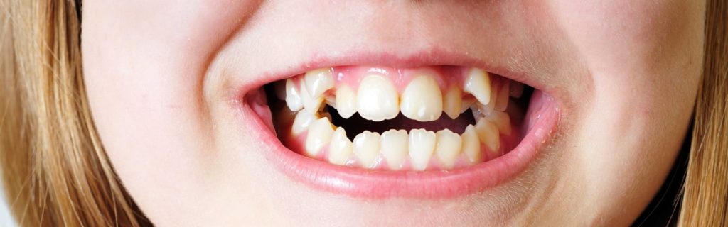 Скученность зубов: причины, стадии, лечение