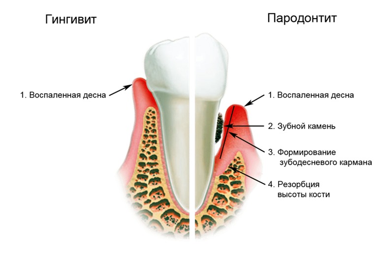 виды воспаления десен