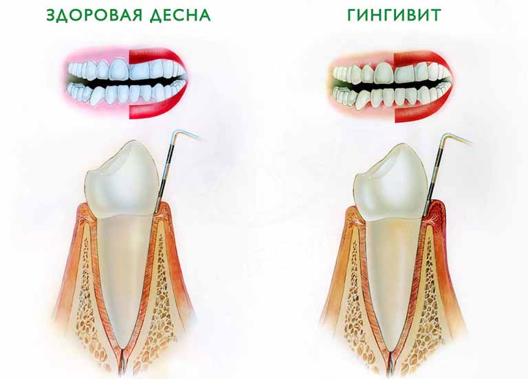 Мягкая десна