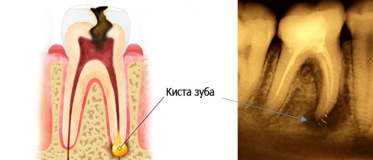 причины появления кисты после удаления зуба