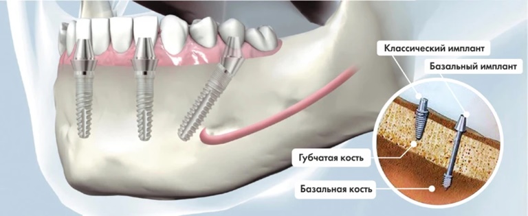 что такое базальная имплантация