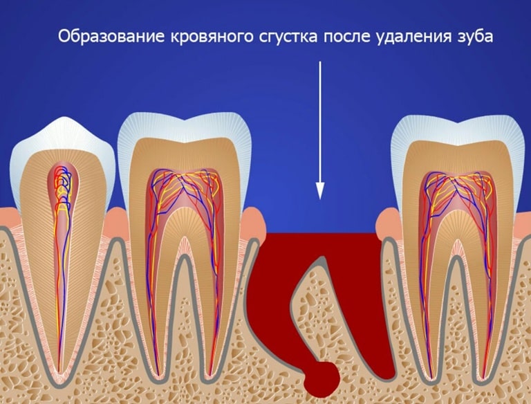 сколько после удаления зуба идет кровь