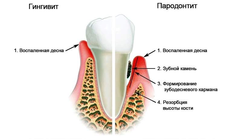 распространенные заболевания десен